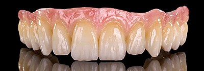 Prettau Zirkon – egy fogtechnikai remekmű