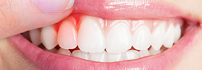 A fogágybetegség (parodontitis) okai, tünetei és kezelési lehetőségei