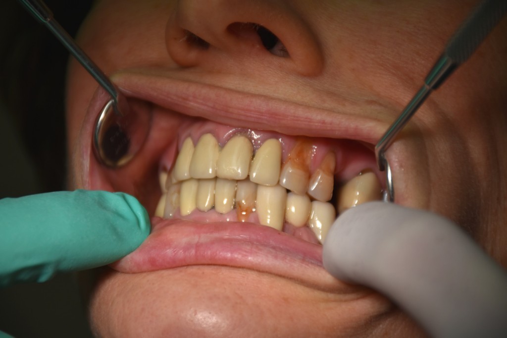 Hogyan akadályozhatom meg a fogíny visszahúzódását?