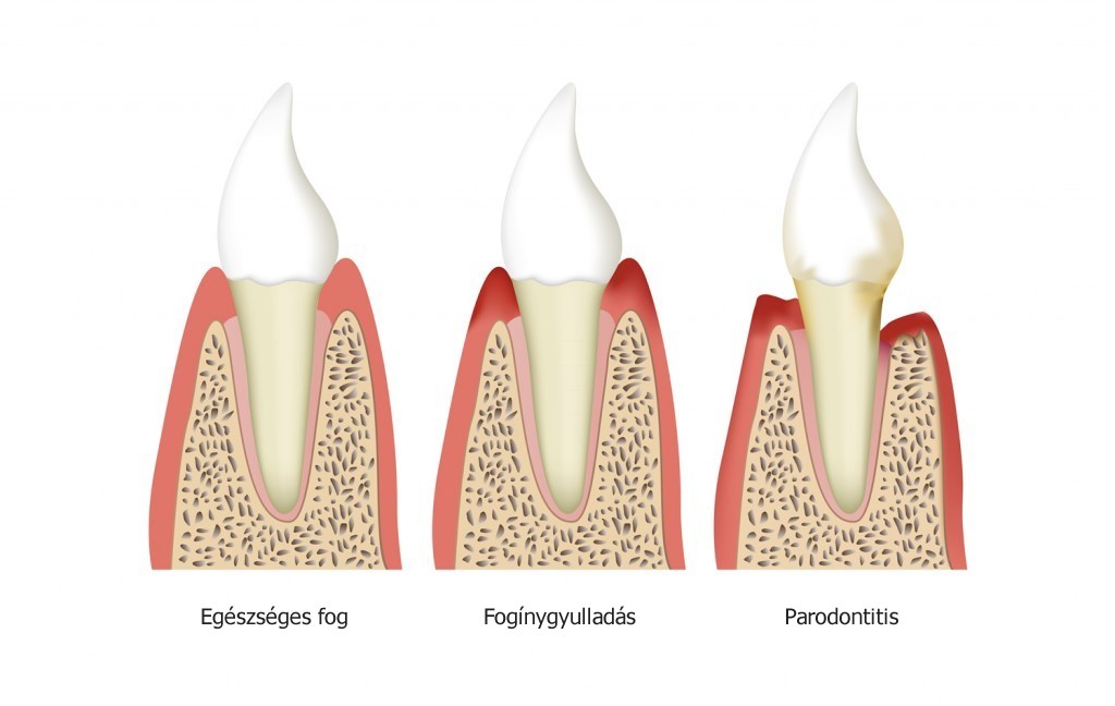 Maradó fogazat, a fogak szerkezete, felépítése, a fogágy (parodontium)
