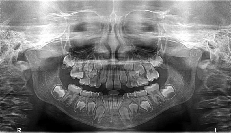 Fogváltás: a 20 tejfogat kilökő 32 maradandó fog fejlődik az állcsontban. Fogváltás: a 20 tejfogat kilökő 32 maradandó fog fejlődik az állcsontban.